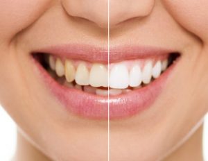 dentis
