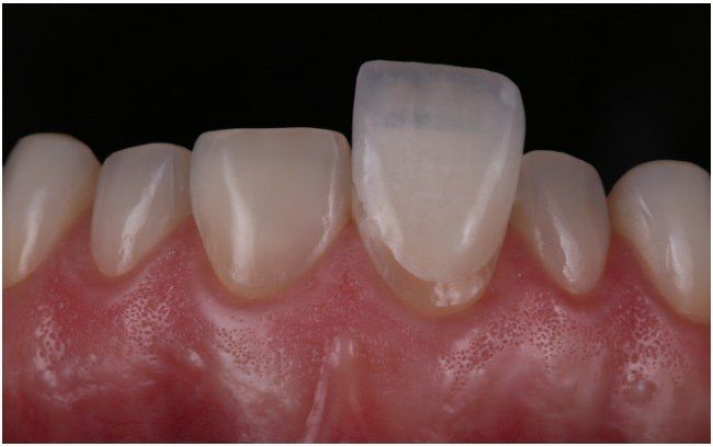 Lente de contato dental: uma alternativa estética