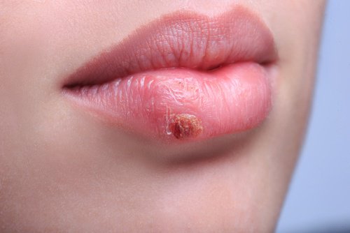 Fique longe do herpes