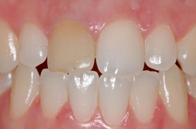 Clareamento em dentes tratados endodonticamente