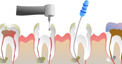 Bactérias e o tratamento endodôntico