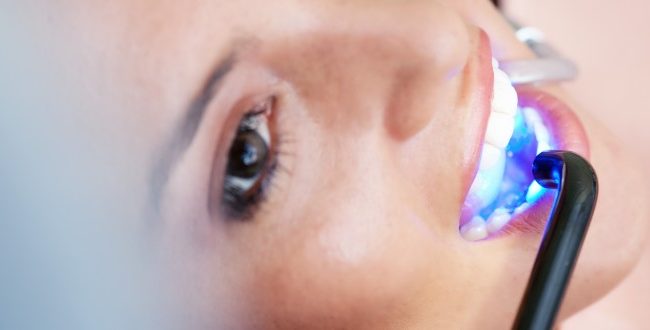 Da resina ao ouro: conheça os materiais mais utilizados nas restaurações dentárias