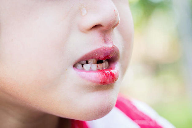 Férias escolares: atenção redobrada com os dentes das crianças